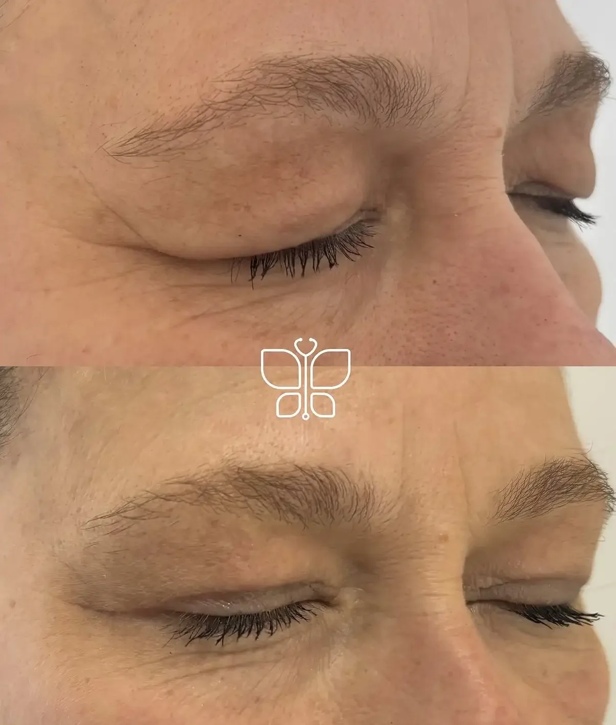 Results of Upper Blepharoplasty.webp