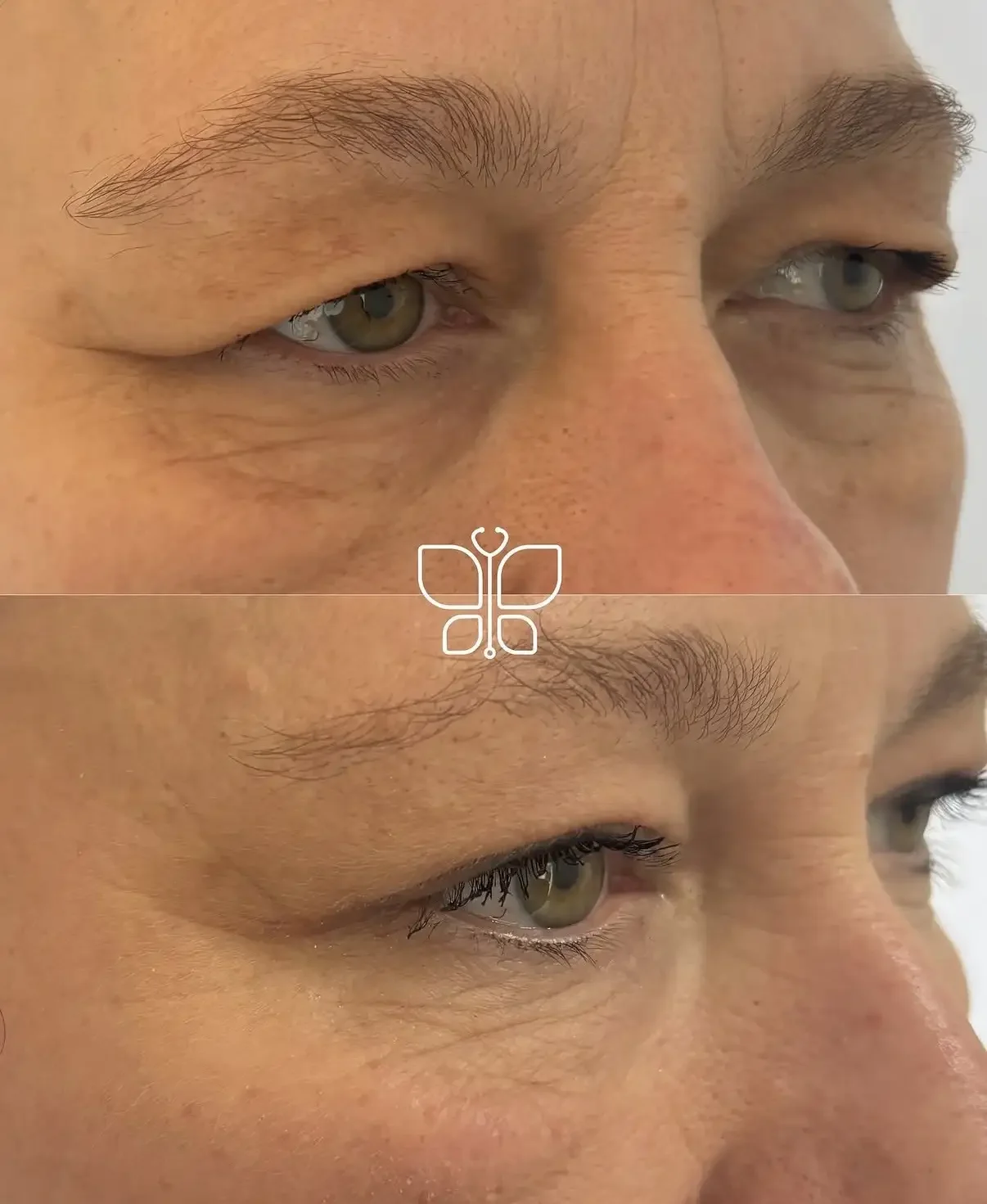 Upper Lid Blepharoplasty Before & After.webp