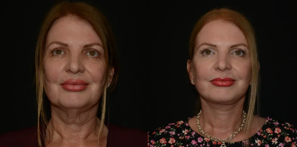 Facelift Surgery Results.webp
