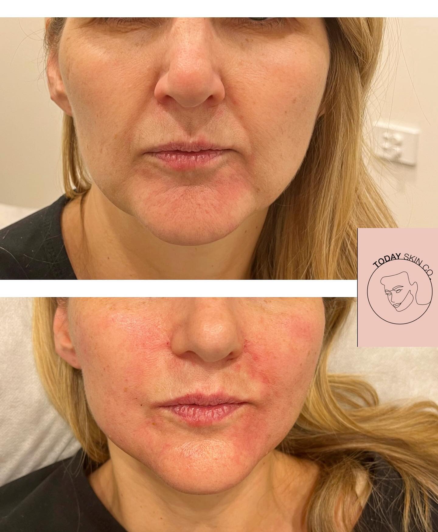 &bull; Filler magic to the lower face makes us look refreshed!! Nose and mouth folds and jowls all softened.