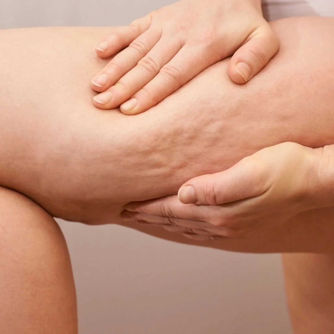 Pourquoi il y plus de cellulite sur les jambes après 40ans (et comment la traiter)