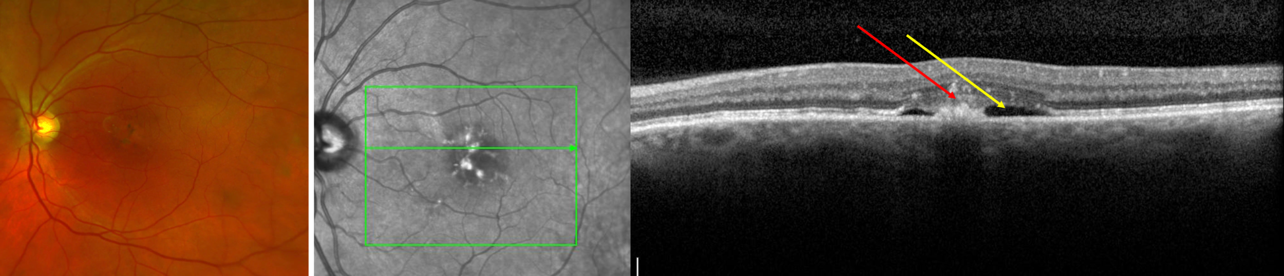 Combined+wet+AMD+image
