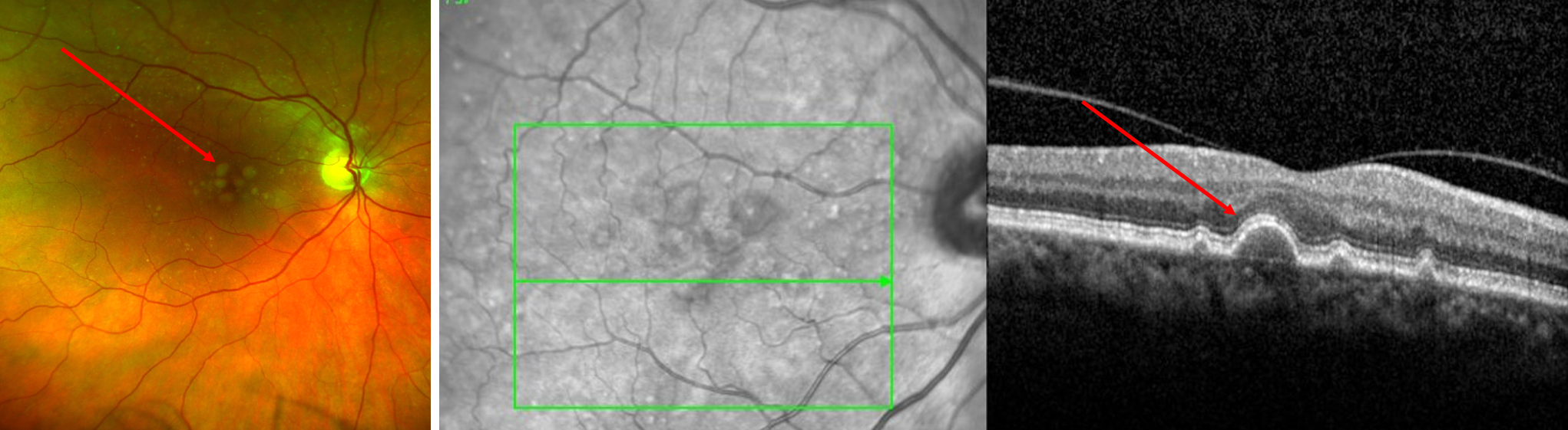 Combined+drusen+photo+and+OCT
