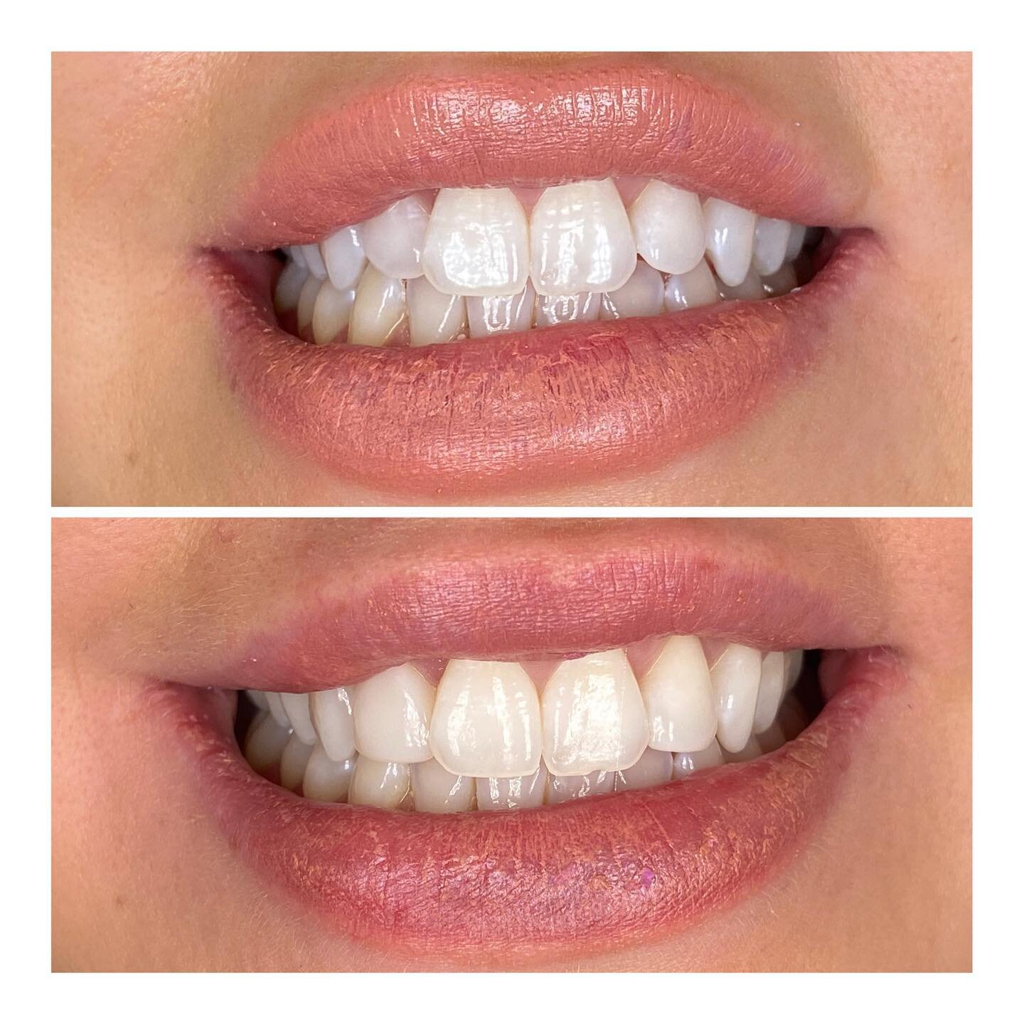 Some little tweaks with composite bonding on the lateral incisors to even out the appearance and mask a slightly rotated tooth. This gorgeous patient was delighted with the results and so was her dentist Dr Kegan Lewis✨✨No injections, no drilling of 