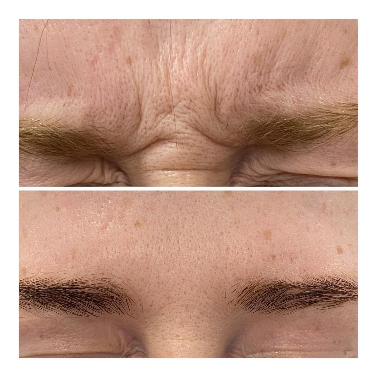 🩼🩼Anti-wrinkle treatment of the frown muscles - a popular treatment with minimal downtime and fantastic results. Lasts for 3-4 months. DM for further information or to book an appointment with our injector Dr Kegan Lewis. #antiwrinkletreatment #gla