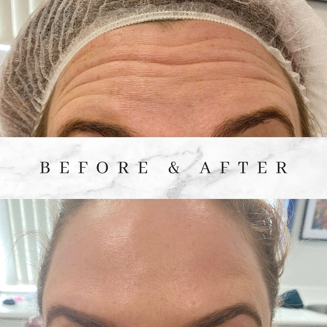 🤩🤩🤩 This gorgeous gal was delighted with results of her anti-wrinkle treatment - and so are we! 🤩🤩🤩 

Softening lines that are beginning to form during movement will reduce the formation of lines visible at rest.  Not only that but when the upp