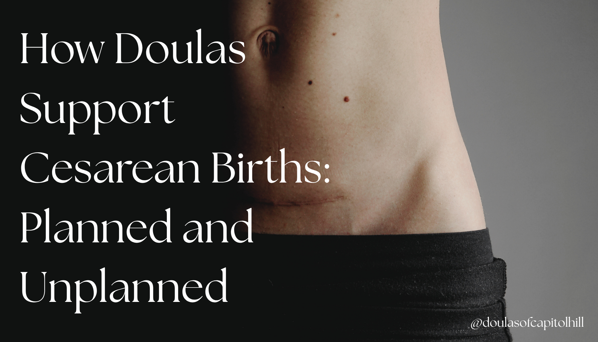 How Doulas Support Cesarean Births: Planned and Unplanned