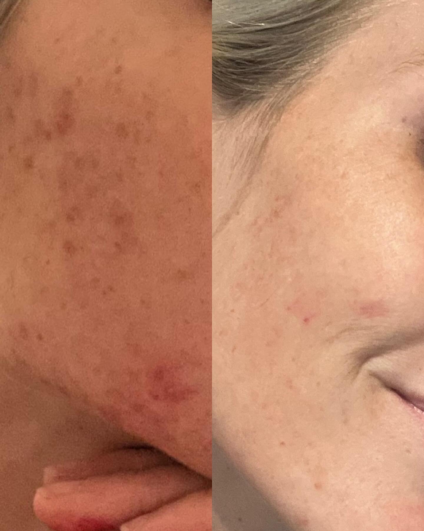 Time + consistency is ALWAYS where the magic happens in skin care. 
Results from PRODUCTS ONLY for a lovely virtual client + mama. 

.
.
.
#acne #acnetreatment #acnejourney #acnefree #acneproneskin #acnefighter #acnefighter #santacruz #dmk #circadia 