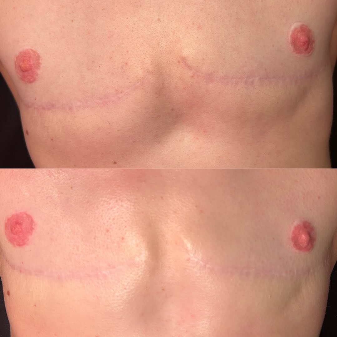 Surgical scar treatment using alkaline wash @dmkinternational .

As you can see after just ONE treatment the scar tissue is already changing! 

.
.
.
#dmk #dmkenzyme #dmkinternational #topsurgery #topsurgerypostop #scarrevision #surgicalscars #skinre