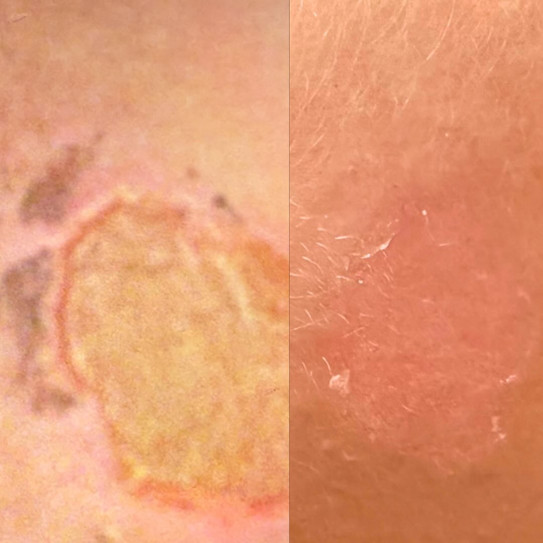 A curling iron burn with about a week between. Using actrol powder! Literal magic powder. 

The first pic is a little blurry, but you can see how bad it was. Thankfully this will not leave a scar. 

@dmkinternational 

.
.
.
#burn #dmk #dmkinternatio