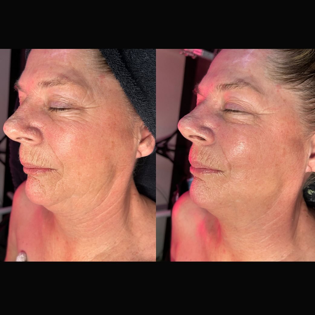 B+ A DMK Muscle Banding 
@dmkinternational 
@dmk_norcal 

How many treatments do you think this was?