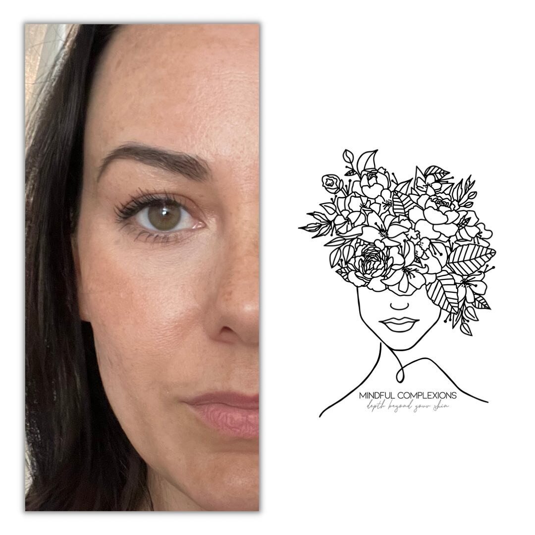 𝐿𝑜𝓋𝑒 𝓉𝒽𝑒 𝓈𝓀𝒾𝓃 𝓎𝑜𝓊&rsquo;𝓇𝑒 𝒾𝓃!
&bull;
No filter, just skin. 
Aging is normal, pimples are normal, melasma is normal, sun damage is normal. 
&bull;
The ideal of perfection is all in your perception. Skin can be healthy and still have