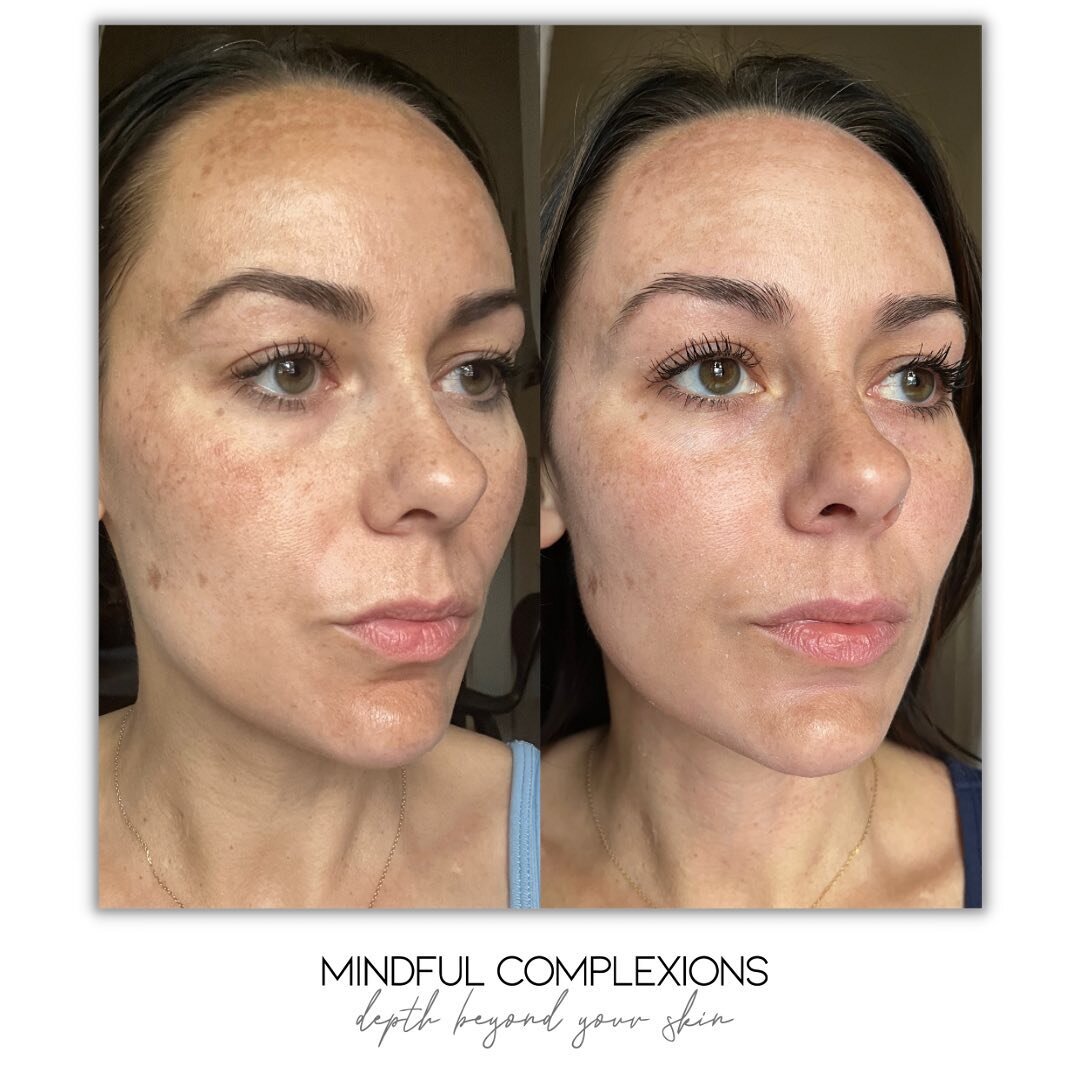𝓖𝓮𝓽 𝔂𝓸𝓾𝓻 𝓹𝓮𝓮𝓵𝓼 𝓲𝓷 𝓫𝓮𝓯𝓸𝓻𝓮 𝓢𝓾𝓶𝓶𝓮𝓻!
&bull;
Treat melasma, hyperpigmentation, sunspots, fine lines, texture, and acne scars with the @theperfectdermapeel. 
&bull;
I&rsquo;m in love with this peel to reset, and refresh the skin o