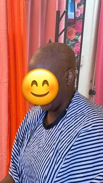 Before-Bald