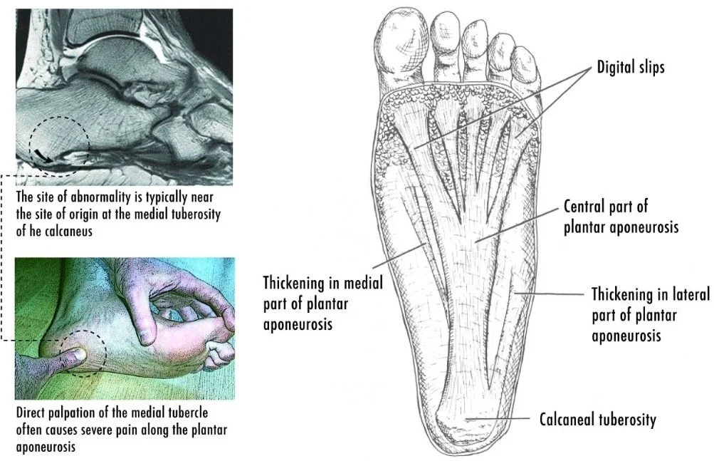 plantar fasciitis