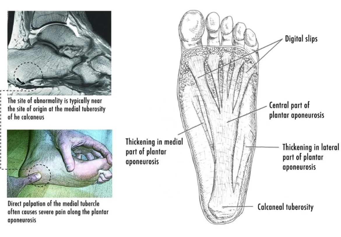 plantar fasciitis