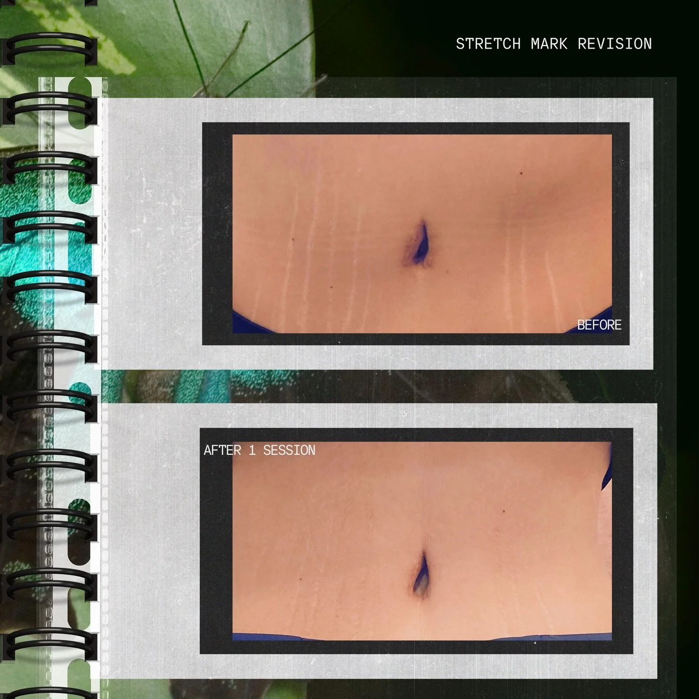 1 session. Real skin. Real results. 🦋

Stretch mark revision after just ONE session.
This treatment works by creating controlled micro-injury to stimulate collagen + elastin production while blending pigment for a more even appearance.

Multiple ses