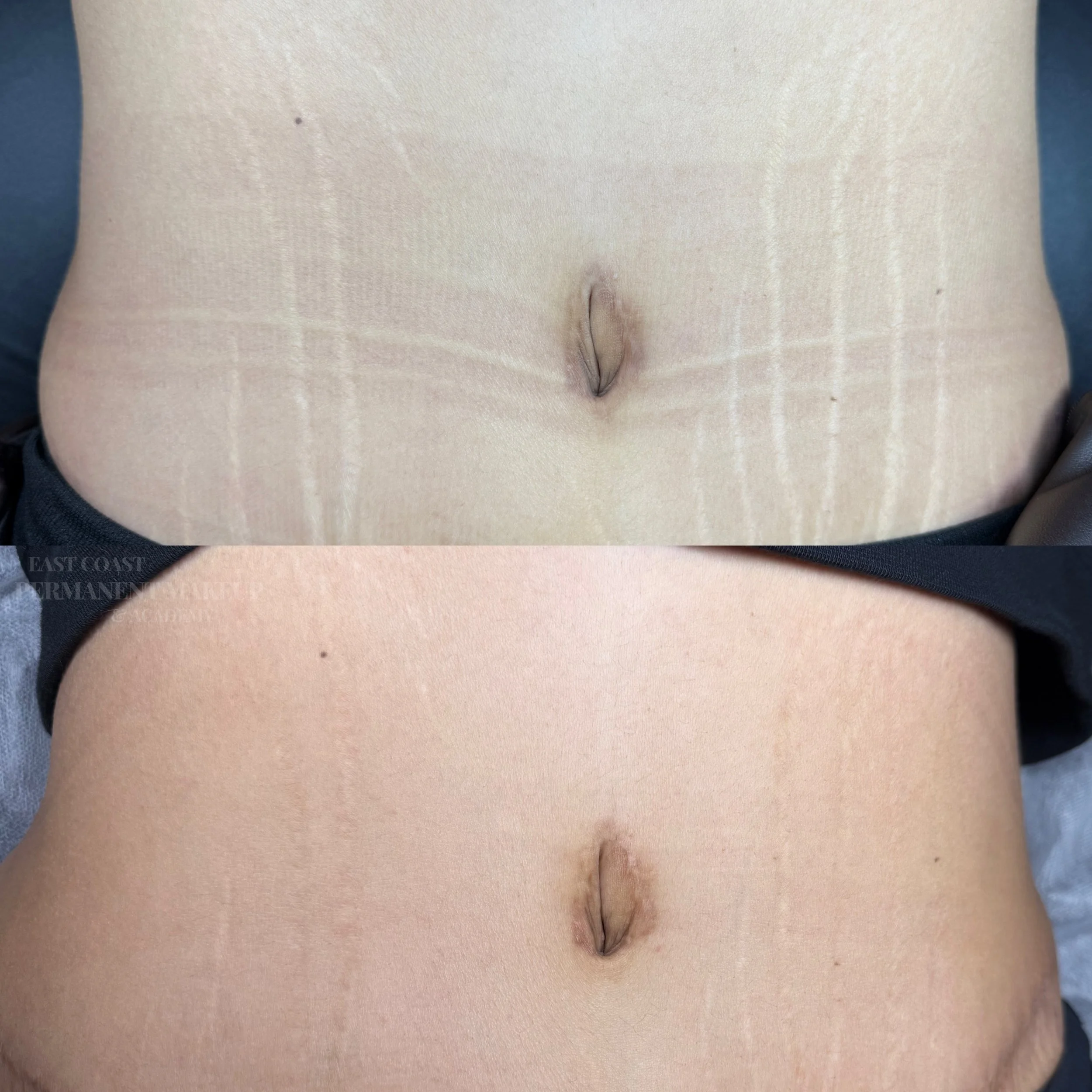 Scar Revision & Stretch Mark Camouflage