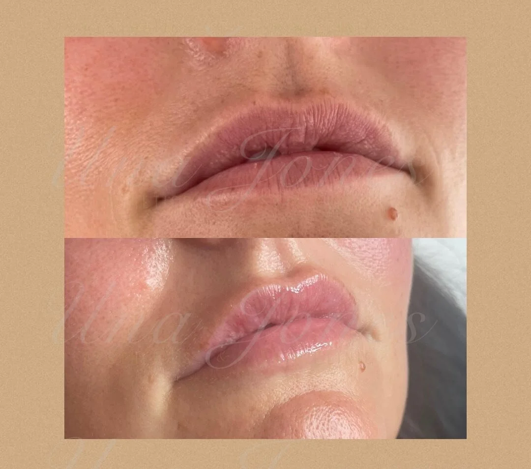 Lip correction and alignment 🫦 #lipfiller #lips #aesthetic #aesthetics #ａｅｓｔｈｅｔｉｃ #essexaesthetics #essexaestheticsclinic #dermalfillers