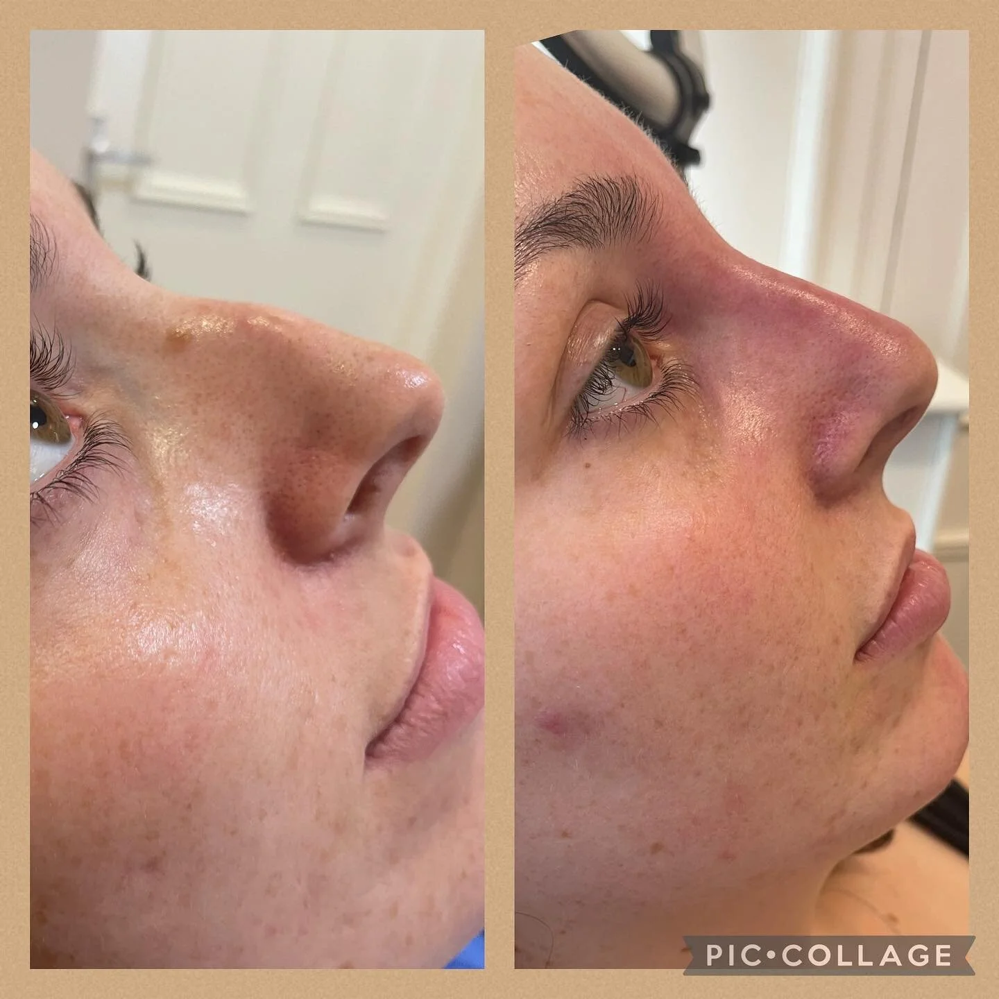 Non surgical rhinoplasty 😍#nonsurgicalnosejob #nonsurgicalrhinoplasty #nosefiller #dermalfiller #aesthetics #aesthetic #ａｅｓｔｈｅｔｉｃ #essexclinic #essexaestheticsclinic #essexaesthetictreatments #witham