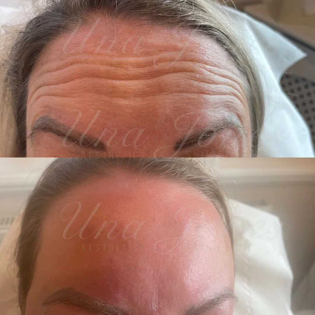 Anti-wrinkle treatment- Immediately after the second top up session (which is included in all our prices)

Message us with any queries #antiwrinkletreatment #antiwrinkle #foreheadwrinkles #aesthetics #ａｅｓｔｈｅｔｉｃ #essexaestheticsclinic #essexaesthetict