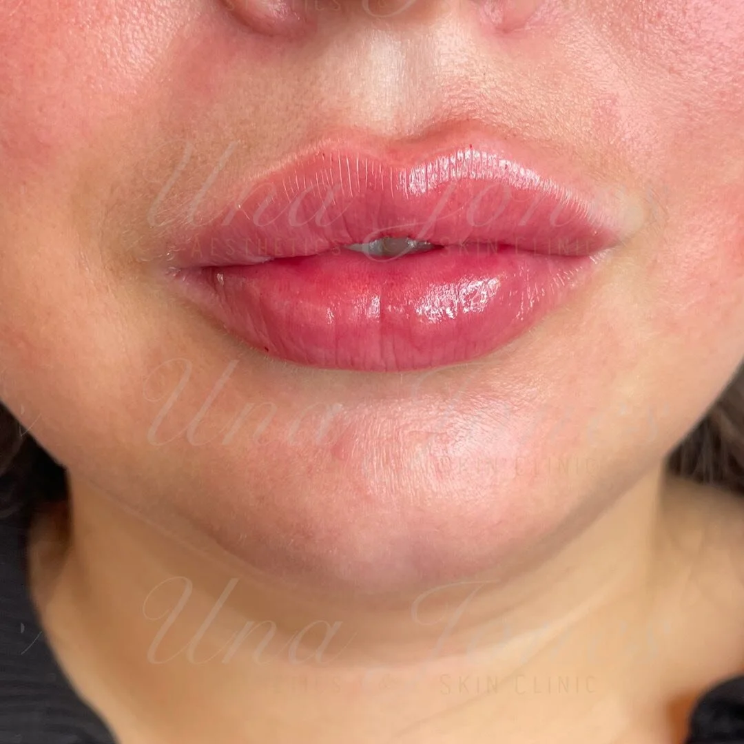 Happy Friday everyone 🫦

We hope you have a great weekend! 
UJ xxx 
#aesthetic #ａｅｓｔｈｅｔｉｃ #aesthetics #lipfiller #dermalfillers #essexaestheticsclinic #essexaesthetictreatments