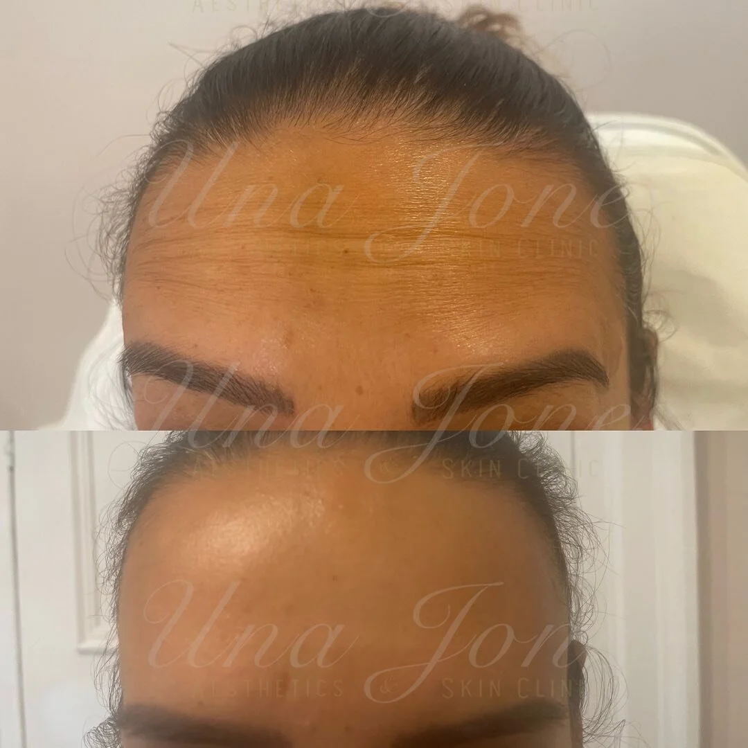 Another day another anti wrinkle treatment. 
One of our most popular treatments at the moment 🥰 

#antiwrinkletreatment #byebyewrinkles #aesthetics #ａｅｓｔｈｅｔｉｃ #essexaesthetictreatments #essexaestheticsclinic #witham