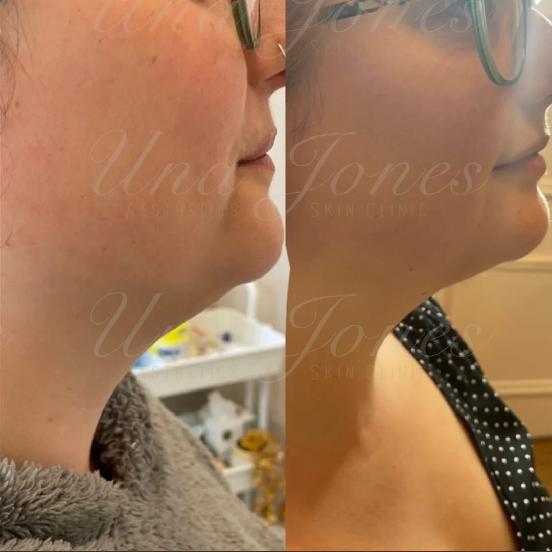 Fat dissolving in the chin/jaw area. Currently discounted to &pound;70 

#fatdissolvinginjections #fatdissolving #aesthetic #ａｅｓｔｈｅｔｉｃ#essexsmallbusiness #essexaestheticsclinic #essexaesthetictreatments #essexaesthetics