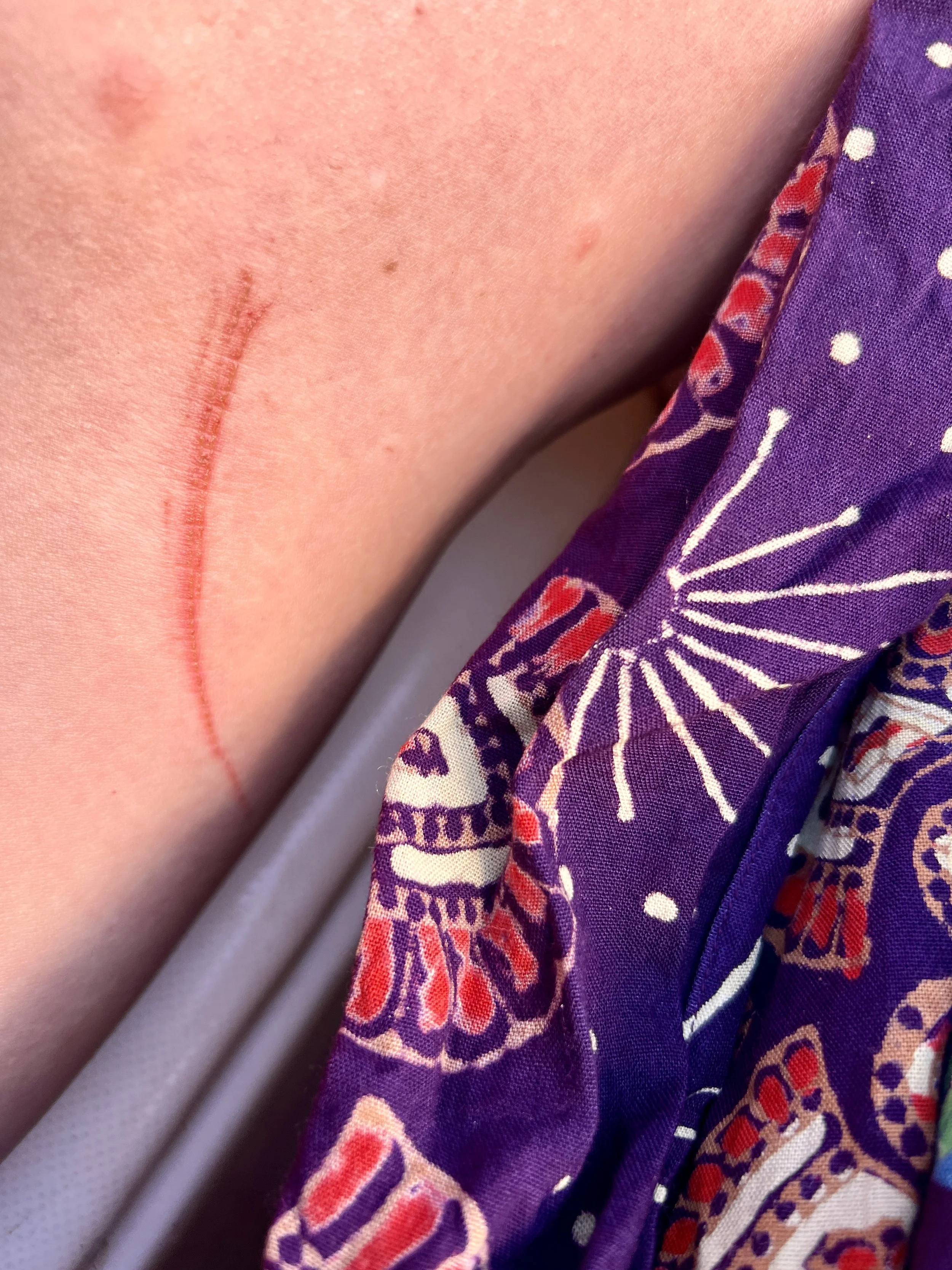 Wound #2
