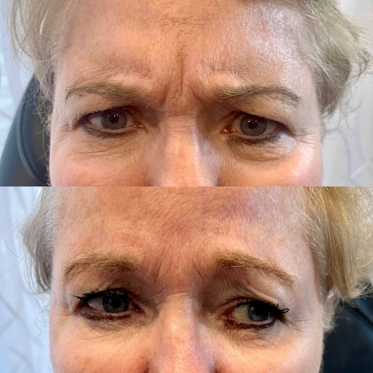 Deep static lines can be dramatically reduced with regular neurotoxin treatments every 3-4 months. 
Such is the case for this client who had a deep line in the middle of her brow that she noticed with and without expression.  She has been receiving t