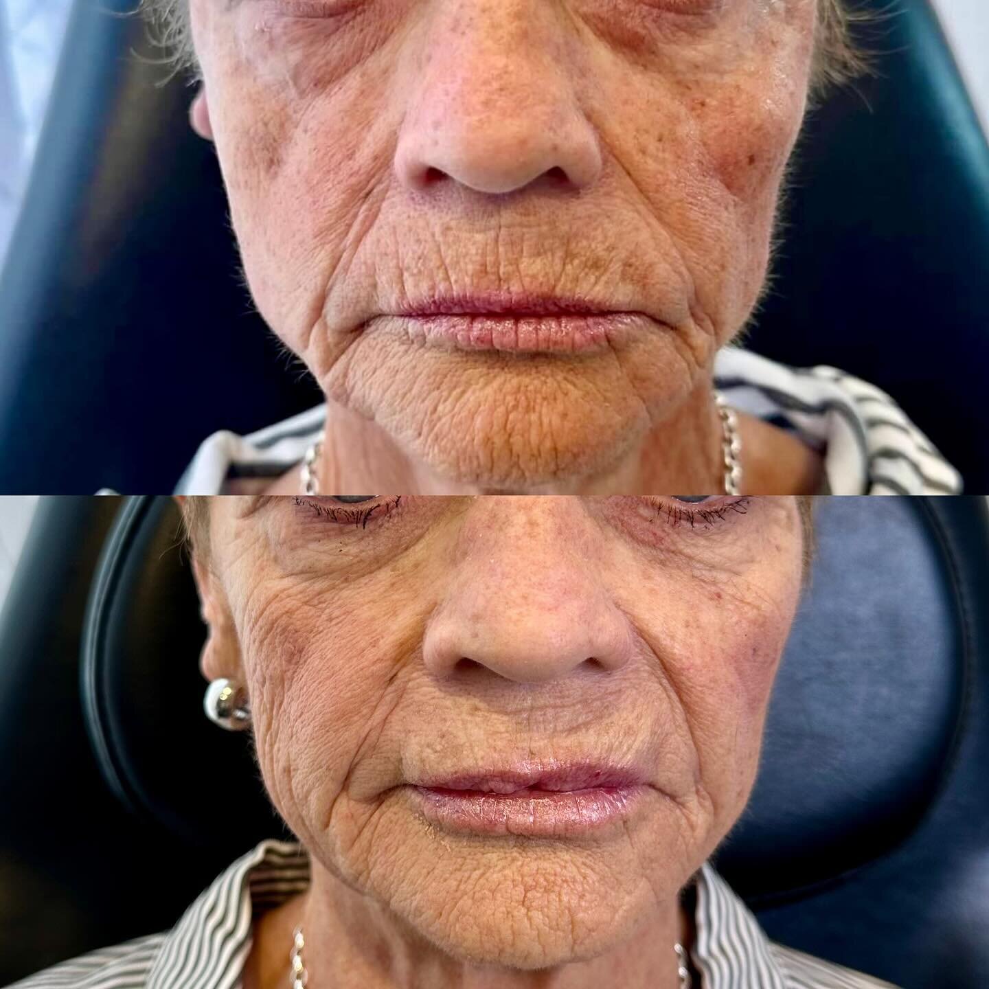 I love what Sculptra can accomplish!
This patient presented with significant volume depletion and after 3 treatments over 3 months with Sculptra she has some noticeable improvement. 

Lips treated with RHA Redensity with a huge improvement  in the pe