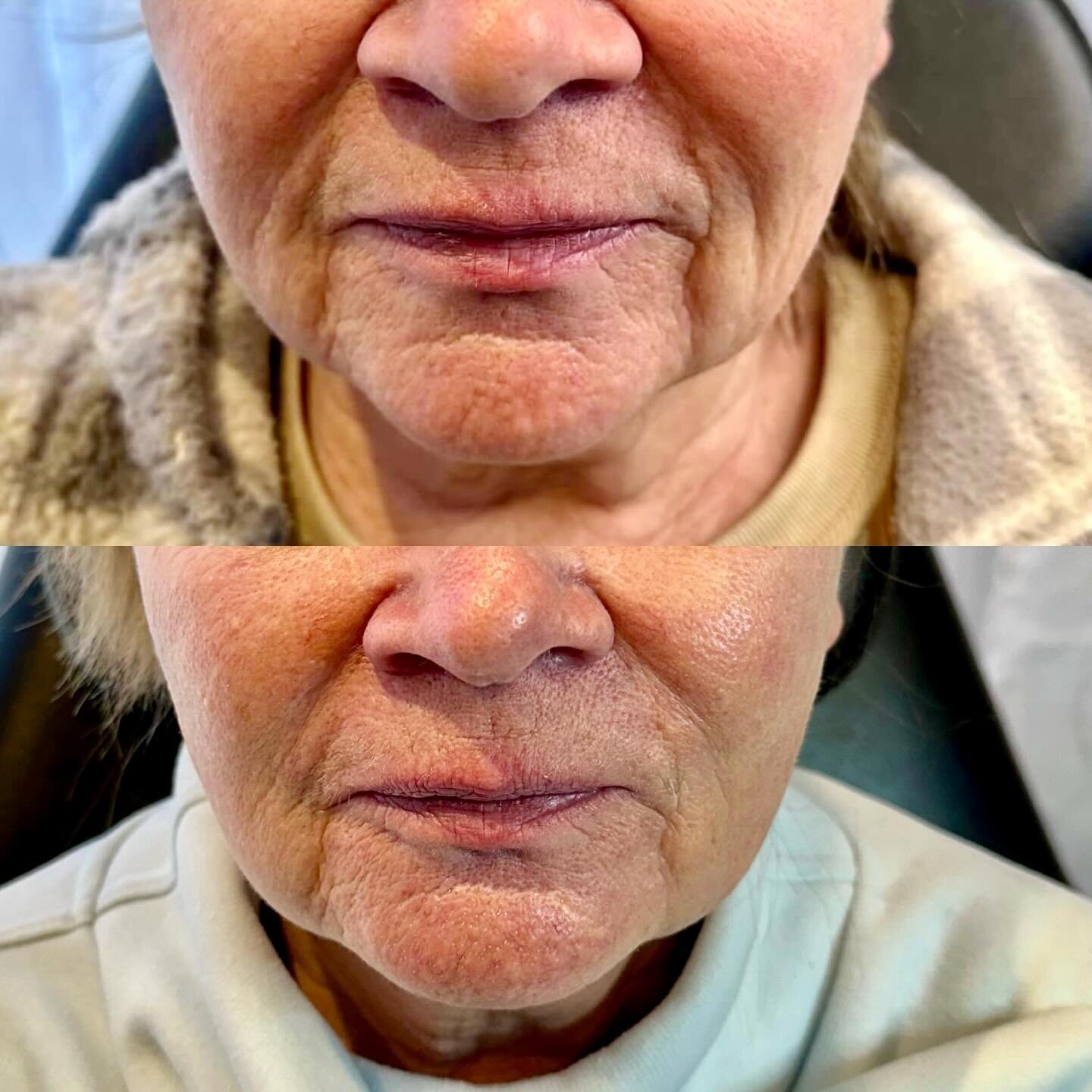 2 Sculptra treatments completed and already showing amazing results.  One final treatment to go 

Sculptra is a bio-stimulating filler that triggers, a process of collagen production, helping to restore lost volume and giving an overall more youthful