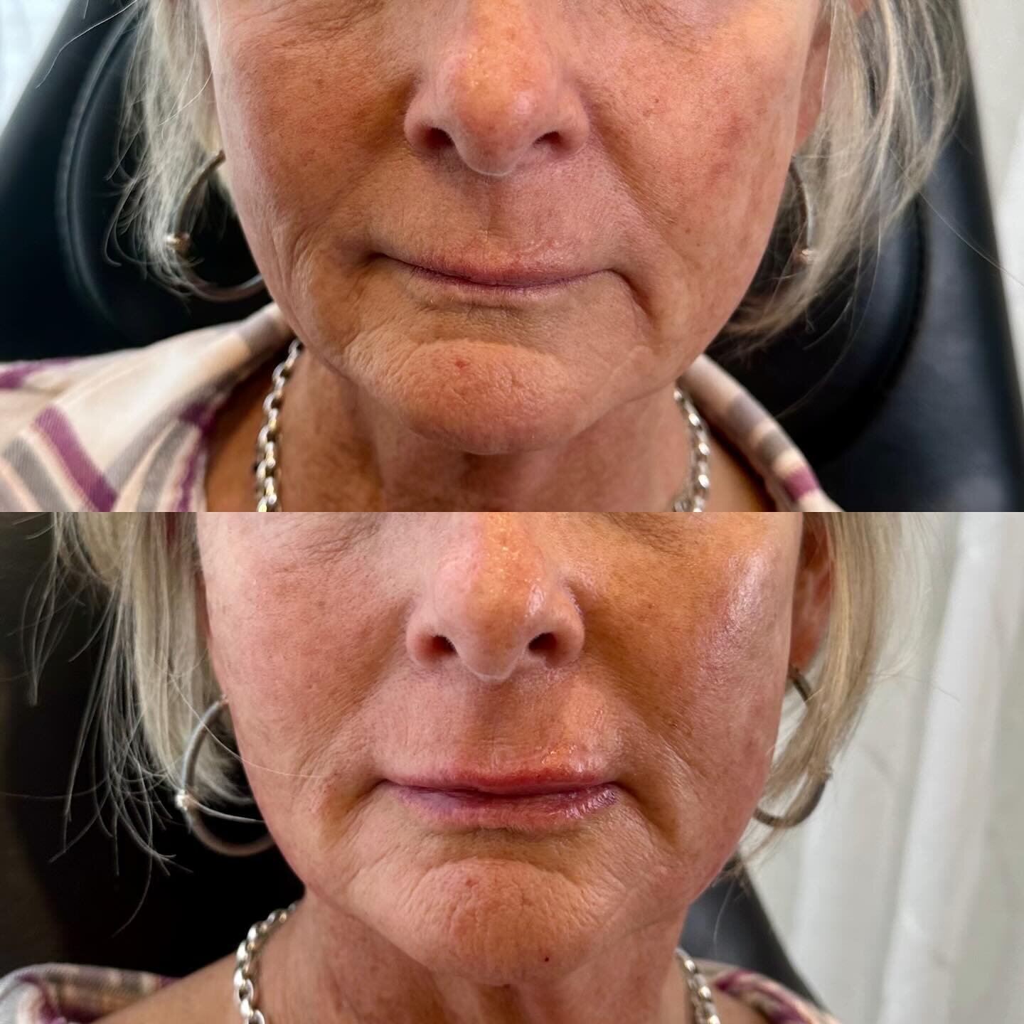 A little Restylene went a long way for her cheeks and jawline and gave this client nice refreshed look.
Redensity was used to give her a soft, natural lip.

Want to freshen up your look?
Book a complimentary consultation to see what treatment might b