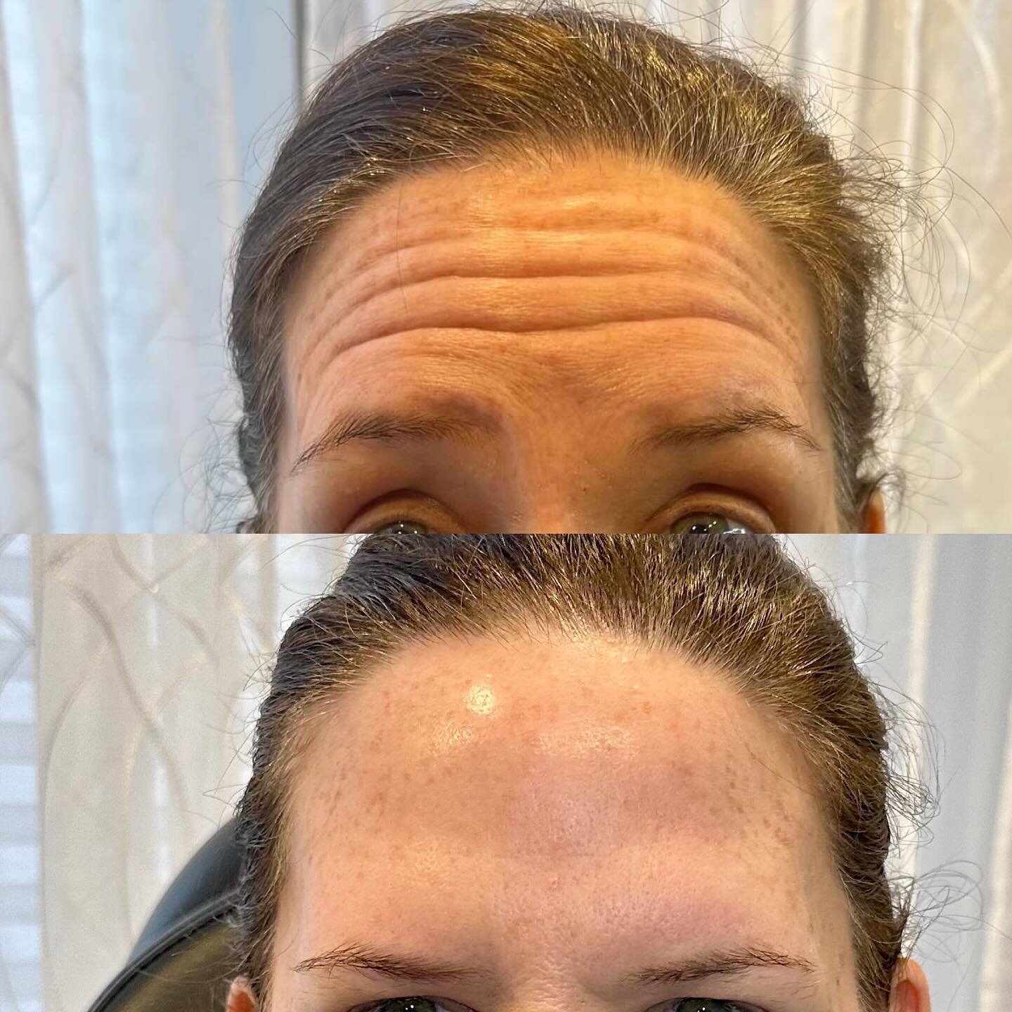 Celebrate your own birthday: This lady spent her 50th with me!

We treated her forehead and 11&rsquo;s and she has a younger more refreshed appearance. 

Come in on your birthday and get $50 off.
Sign up for Aspire, Evolus or Alle rewards and save ev