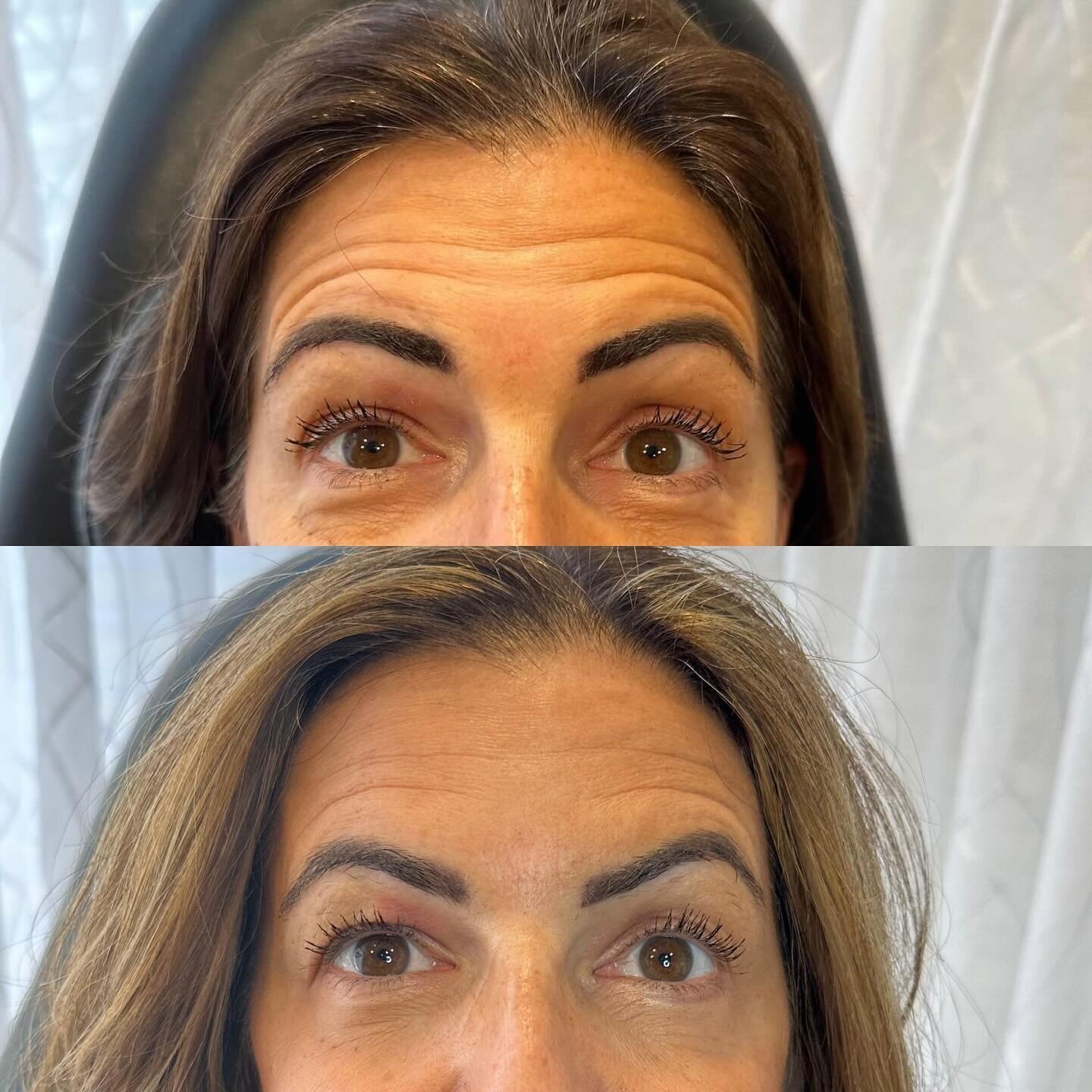 Myth: If I get botox I will look frozen and not be able to make any expressions.

Truth: You can get botox and maintain a natural look that appears younger and more refreshed.

That&rsquo;s exactly what this client requested - a refreshed and natural