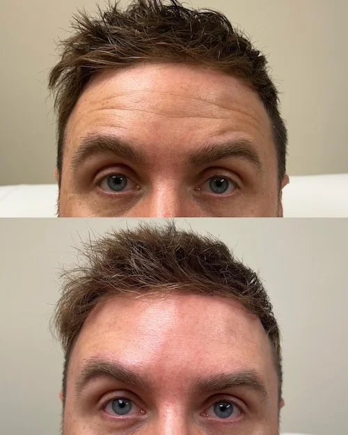 forehead-remove-wrinkles-man-medspa-northshore-ma.JPG