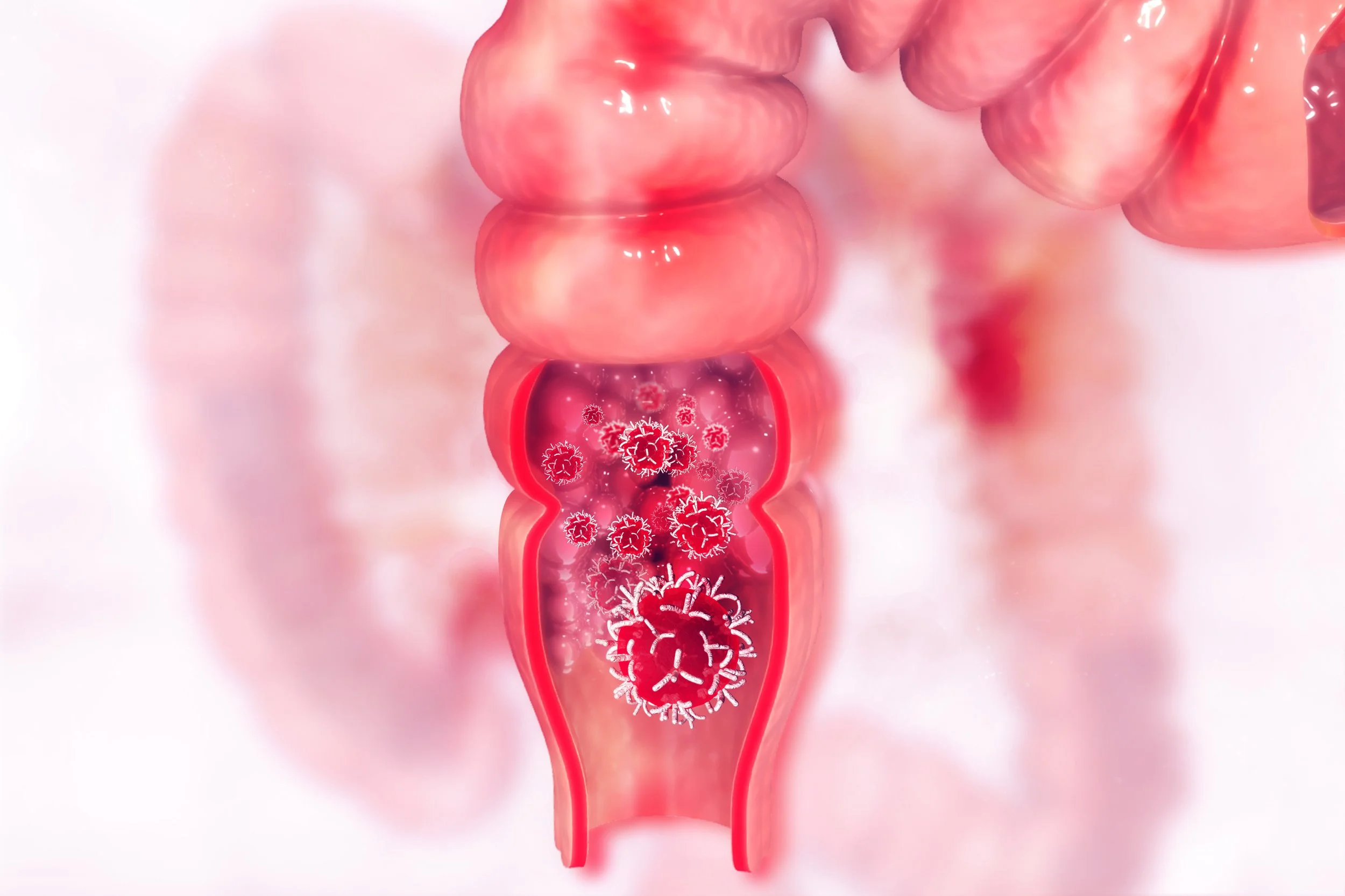 Overview of Anal Cancer