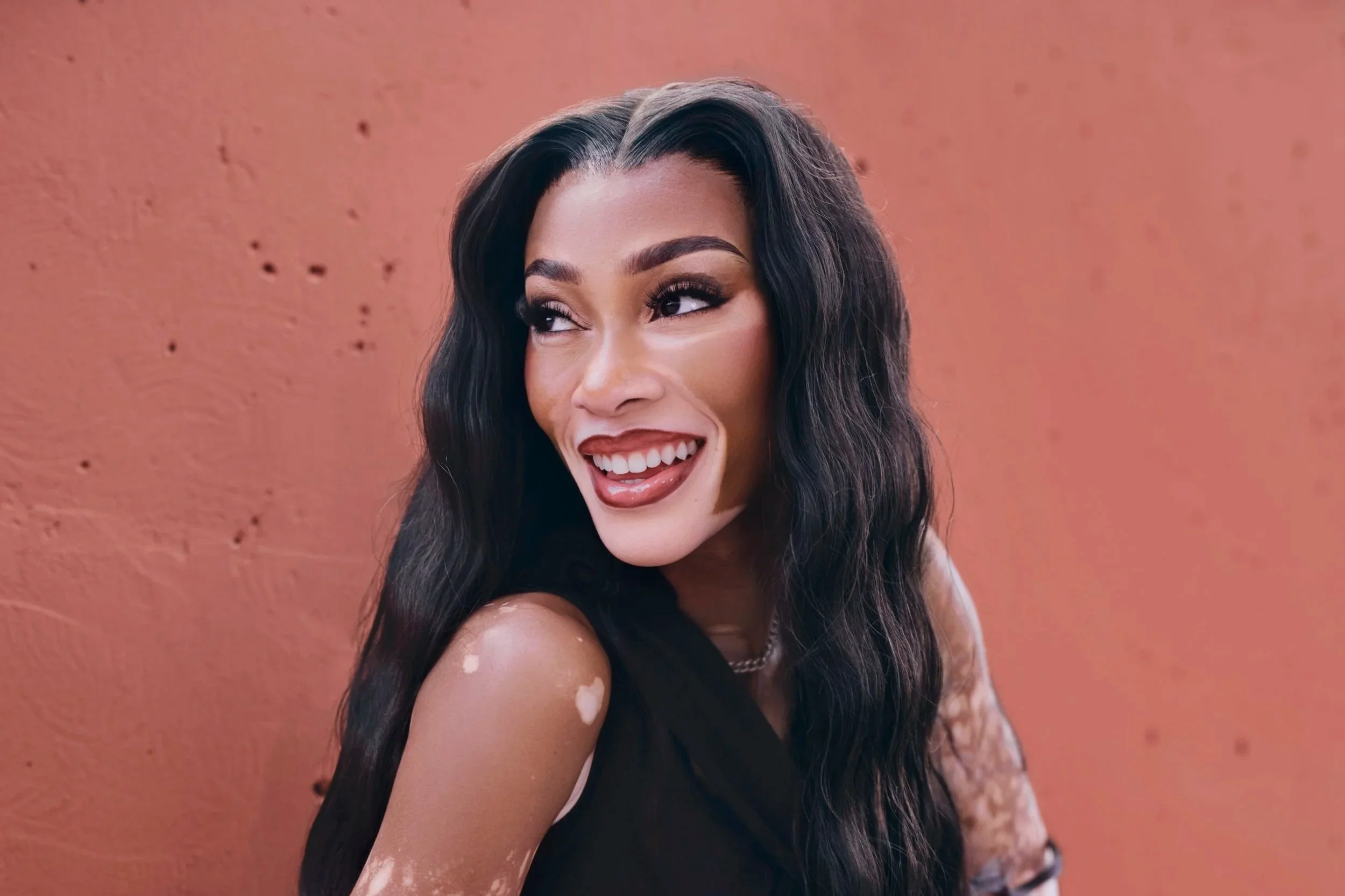 Incyte Partners with Model Winnie Harlow on Vitiligo Awareness Campaign