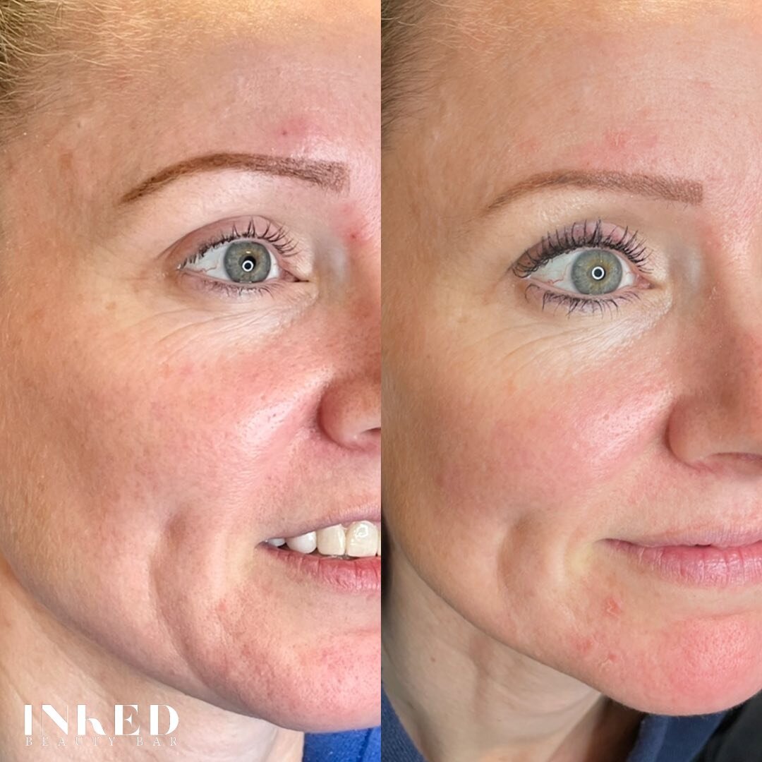 When MICRONEEDLING makes your skin look this SMOOTH!