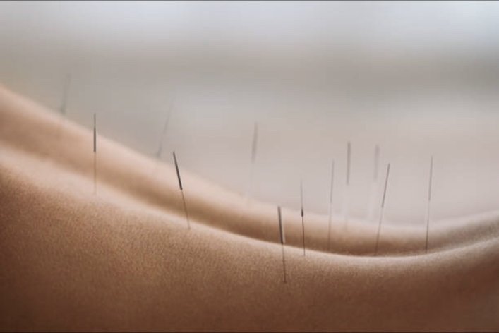 Acupuncture needles inserted into a person's back, with a blurred background of leaves.