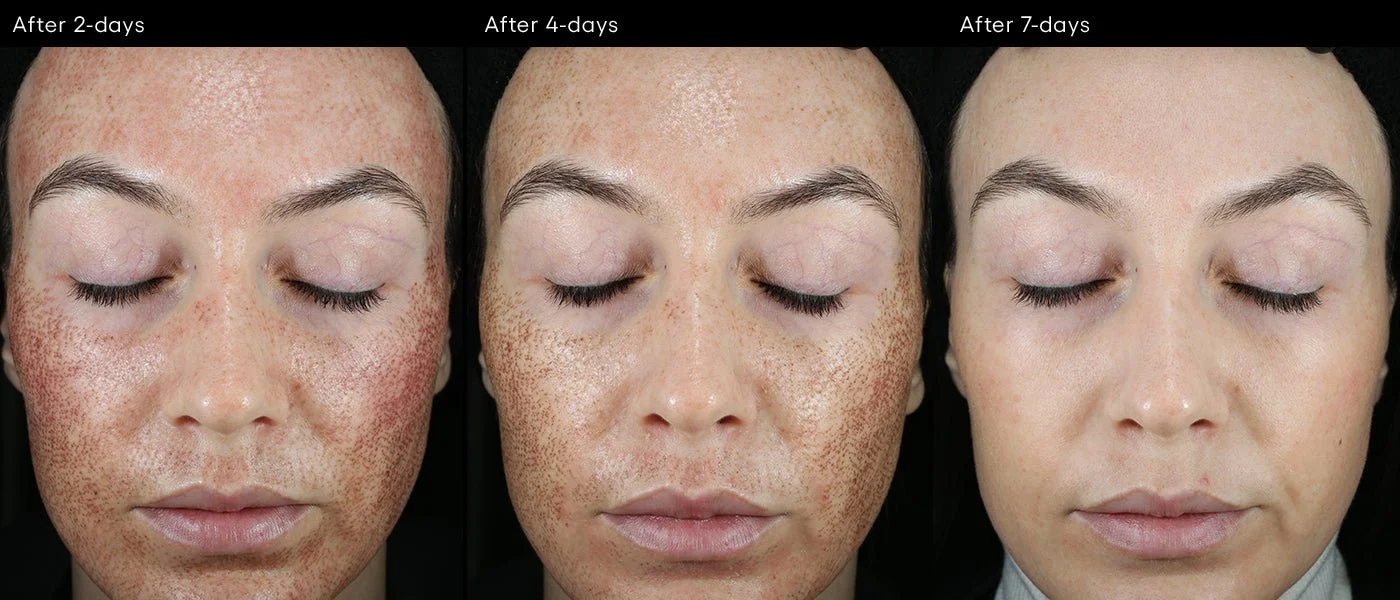 Three images showing progressive facial skin healing progress after 2, 4, and 7 days post-treatment with the use of ( plated ) CALM Serum, with visible changes in redness and texture.