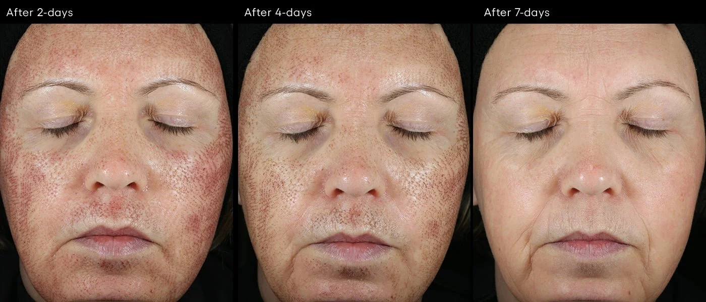 Three images showing progressive facial skin healing progress after 2, 4, and 7 days post-treatment with the use of ( plated ) CALM Serum, with visible changes in redness and texture.