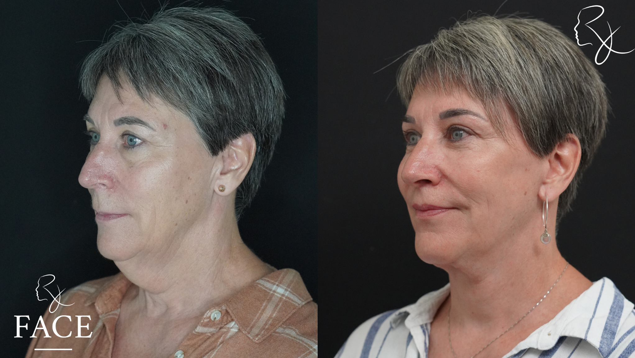 The outcome or results depicted are not
guaranteed and may vary between patients.