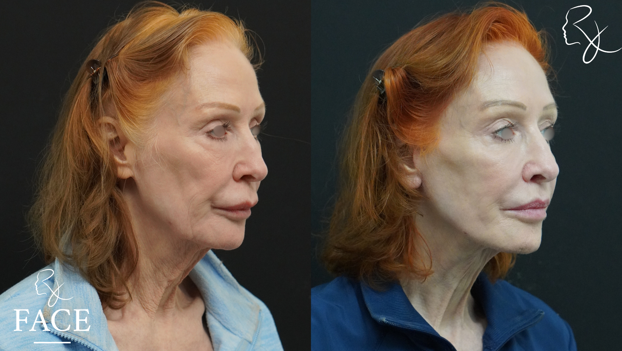 The outcome or results depicted are not
guaranteed and may vary between patients.