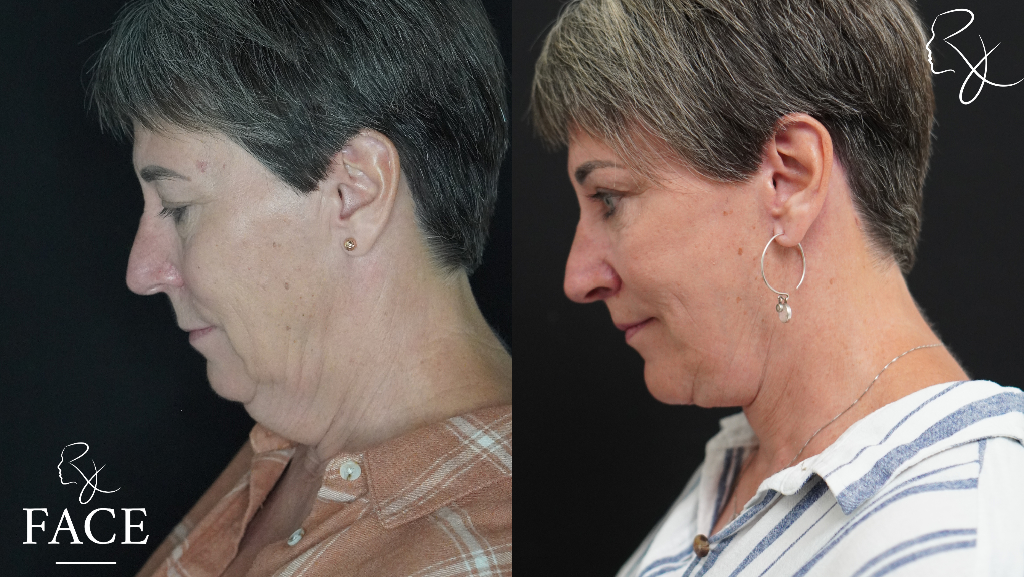 The outcome or results depicted are not
guaranteed and may vary between patients.