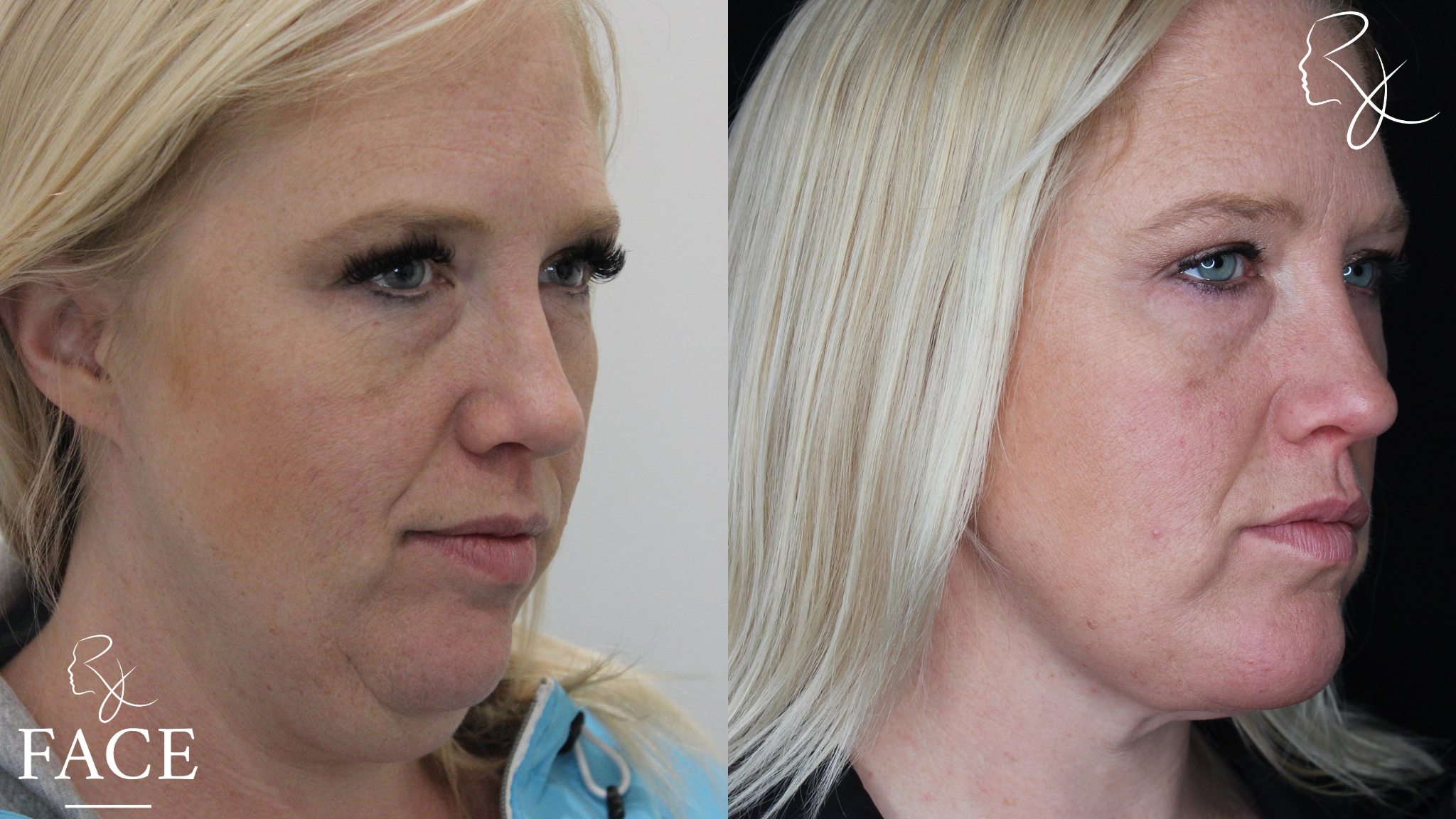 The outcome or results depicted are not
guaranteed and may vary between patients.