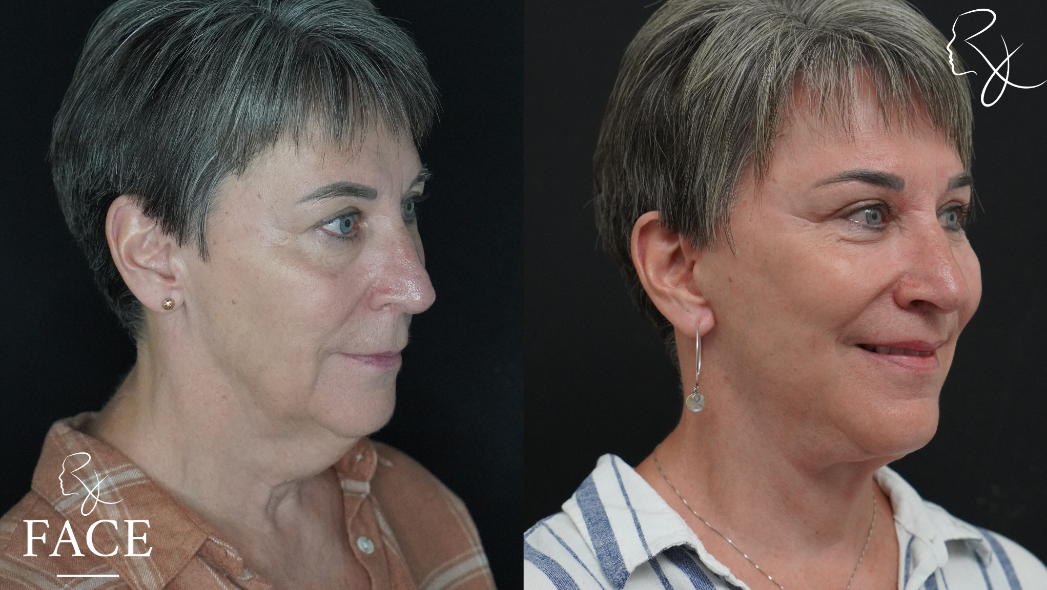 The outcome or results depicted are not
guaranteed and may vary between patients.
