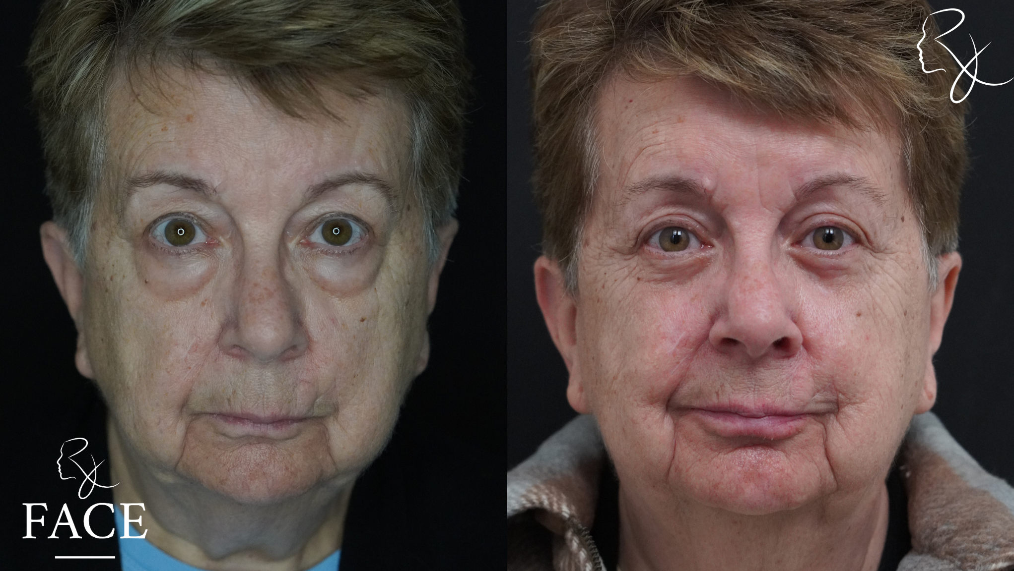 The outcome or results depicted are not
guaranteed and may vary between patients.