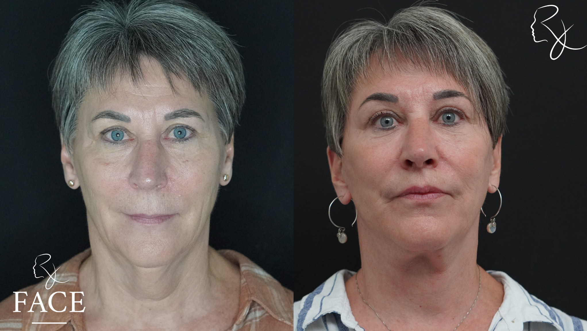The outcome or results depicted are not
guaranteed and may vary between patients.
