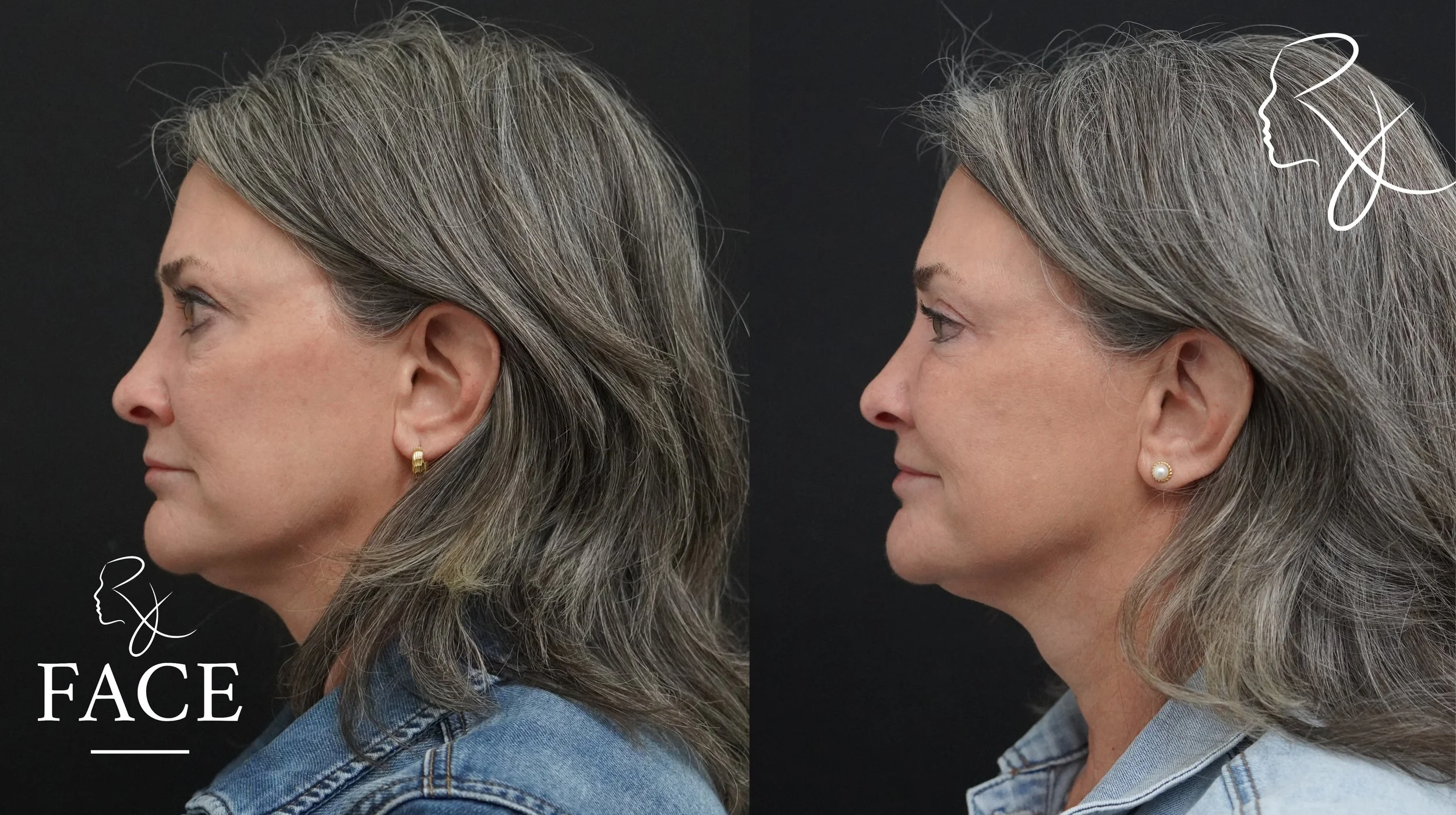 The outcome or results depicted are not 
guaranteed and may vary between patients.